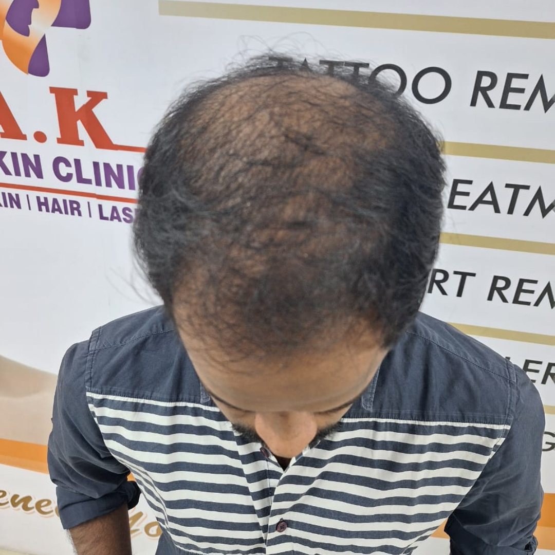 Hair Transplantation - Before