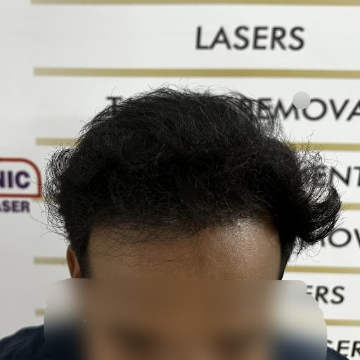 Hairline Restoration Treatment - After