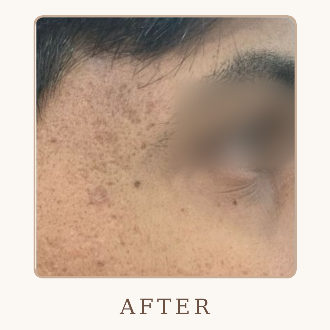 Acne Scar Treatment - After