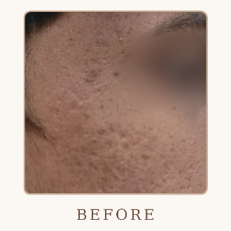 Acne Scar Treatment - Before
