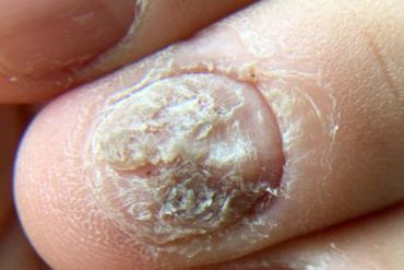 FUNGAL INFECTIONS - AK Clinic