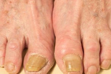 NAIL DISORDERS