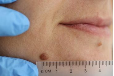 WARTS / MOLES / SKIN GROWTHS REMOVAL